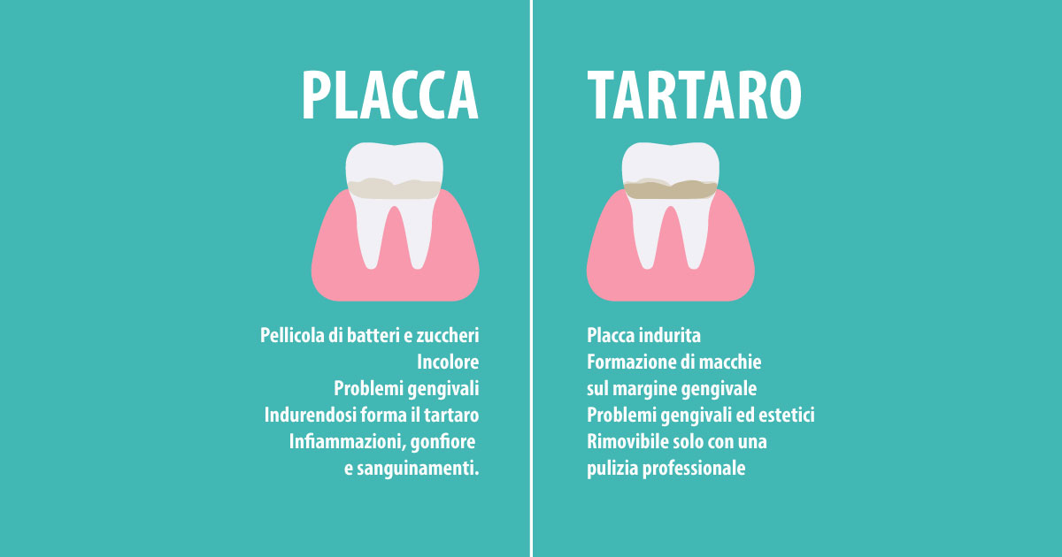 placca-e-tartaro