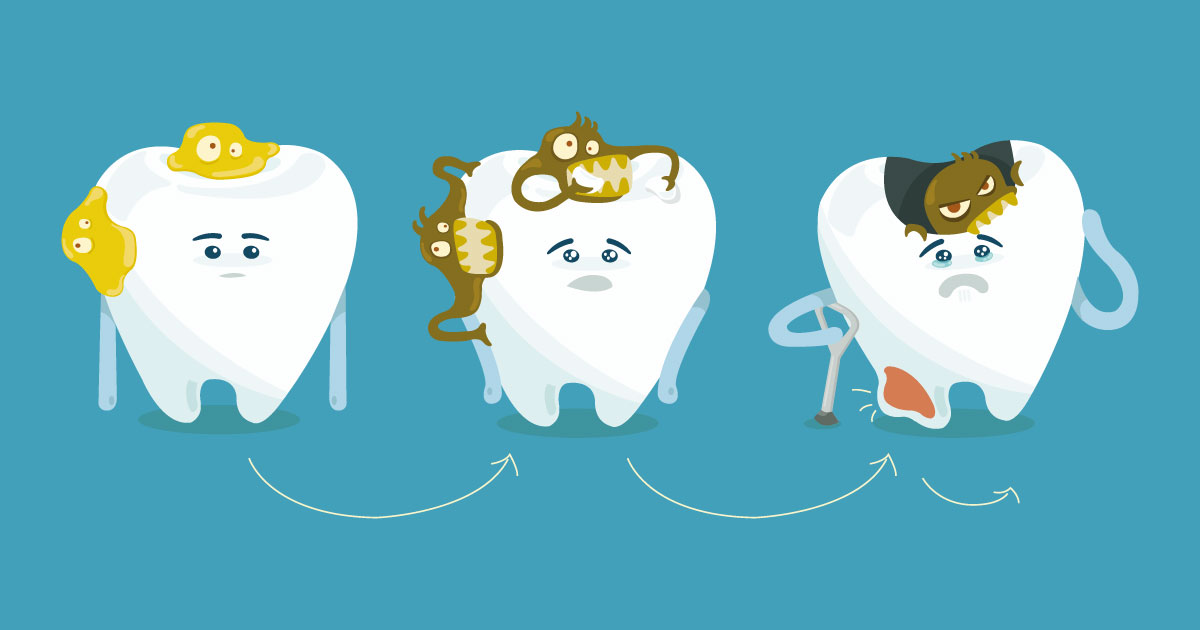 tipi-carie-denti-bambini