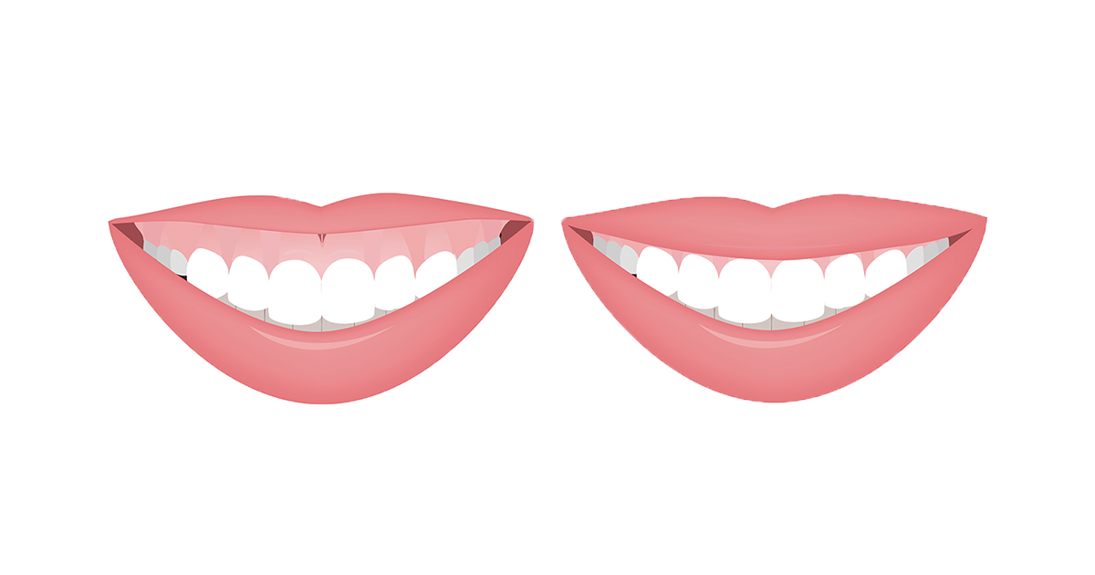 gummy-smile